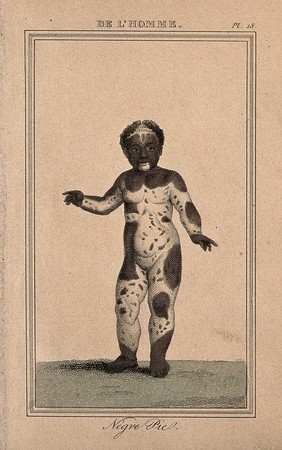 A black child displaying areas of white skin across her entire body (vitiligo?). Etching with watercolour, 1818.