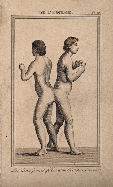 Female conjoined twins, joined at the small of the back. Etching with watercolour, 1818.