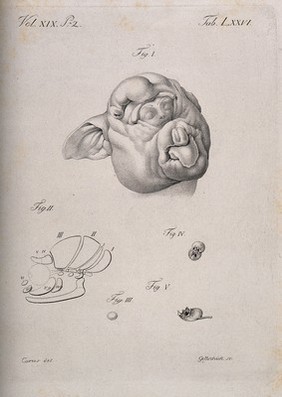 The head of a baby (?), enclosed within the skin of a pig's head, with details showing bones and organs (?). Stipple engraving by Gottschick after Carus, ca. 1820.