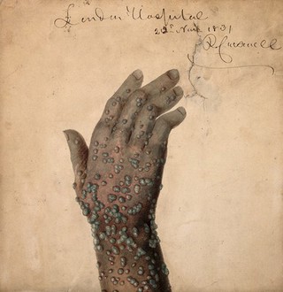 Rash of pustules on the hand of a patient, probably suffering from smallpox. Watercolour by R. Carswell, 1831.