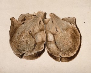 view Section through polypus uteri. Watercolour, 1841.