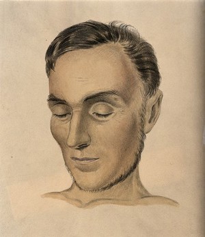 view Face of a man suffering from Addison's disease. Watercolour with chalk, 1849.
