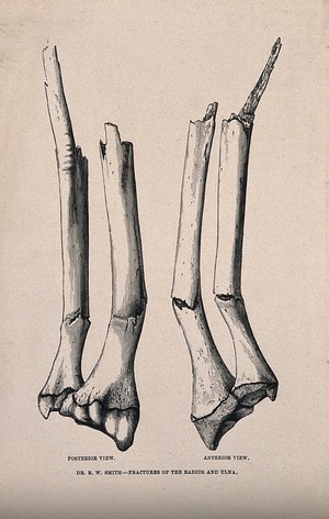 view Fractures of the radius and ulna bones, anterior and posterior views. Line block print after R.W. Smith, 1862.