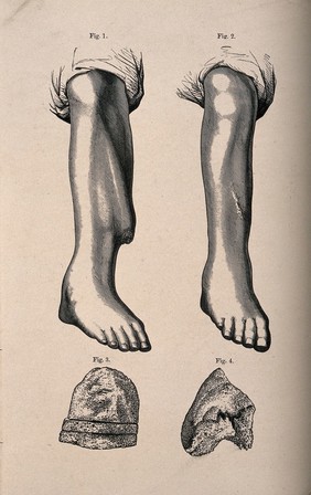 A broken leg, with the tibia bone shown protruding through the skin: four figures, showing the leg before and after surgery, with two details of the bone surface. Line block print after R.W. Smith, 1862.