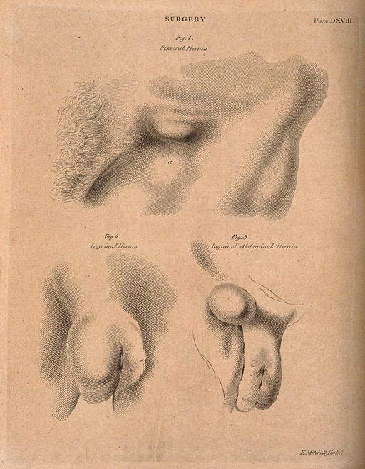 Hernias: a femoral hernia, an inguinal hernia and an inguinal abdominal hernia. Etching by E. Mitchell, ca. 1809.