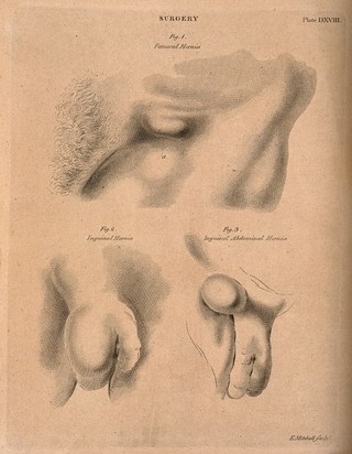 Hernias: a femoral hernia, an inguinal hernia and an inguinal abdominal hernia. Etching by E. Mitchell, ca. 1809.