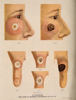view Cowpox: areas of affected skin on the face and thumb of a patient, showing the development of the disease (possibly after vaccination?). Colour lithograph, ca. 1880.
