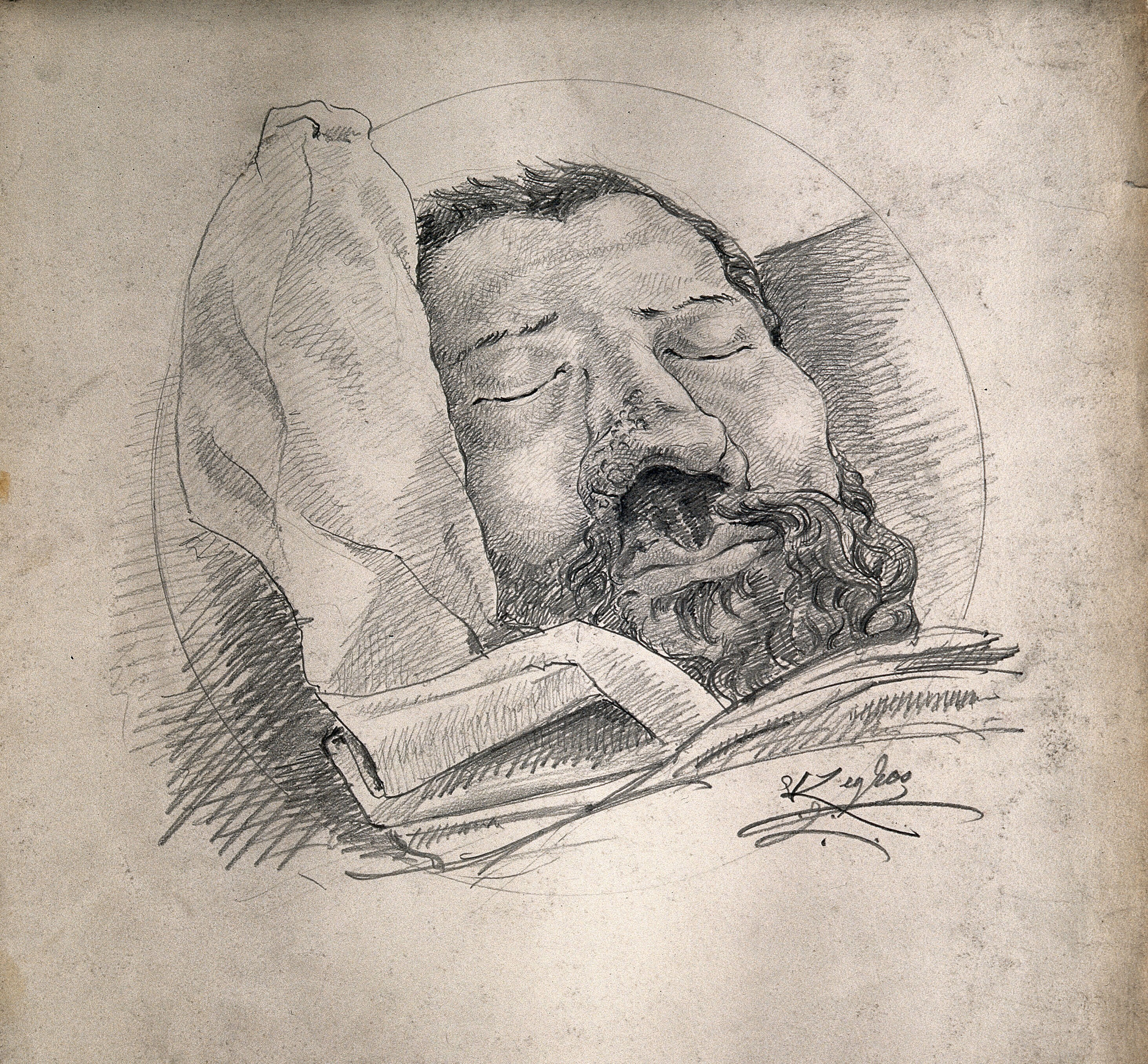 Face Of A Dead Man Suffering From Syphilis Showing A Severely