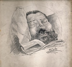 view Face of a dead (?) man suffering from syphilis, showing a severely diseased nose. Pencil drawing by A. Legros, 1885.