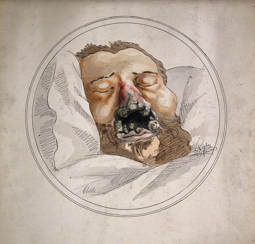 Eroded and gangrenous nasal cartilage due to syphilis, 1885