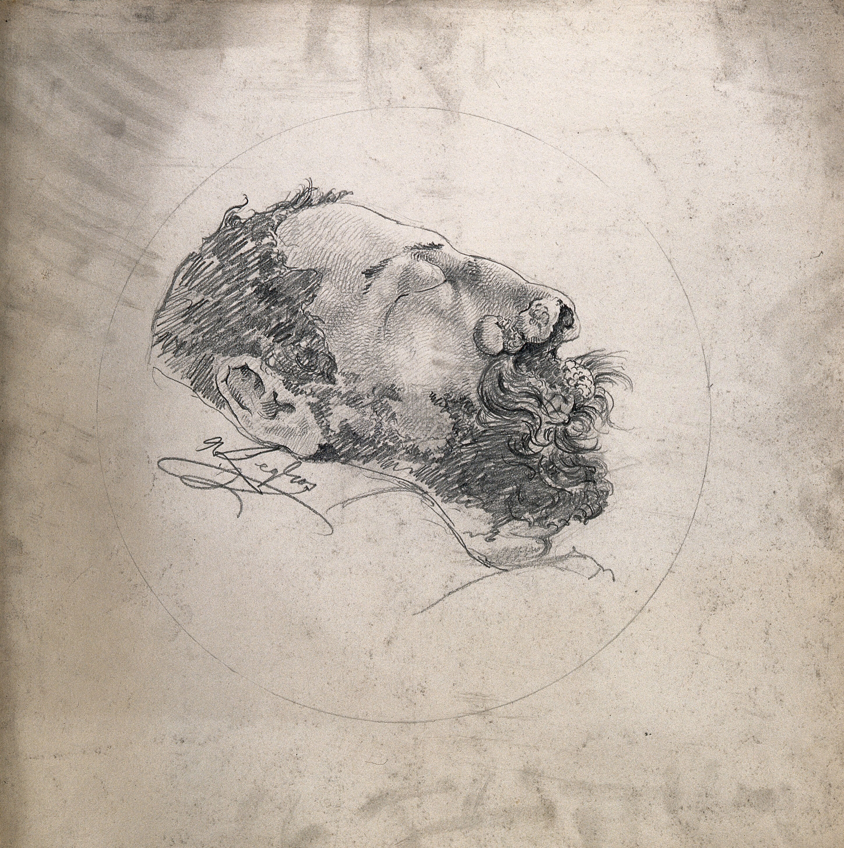 Face Of A Dead Man Suffering From Syphilis Showing A Severely