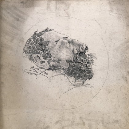 Face of a dead (?) man suffering from syphilis, showing a severely diseased nose. Pencil drawing by A. Legros, 1885.