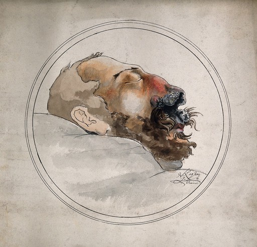 Syphilis; face of a dead man with erosion of the nose, 1885