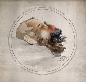 view Face of a dead (?) man suffering from syphilis, showing a severely diseased nose. Watercolour with ink by A. Legros, 1885.