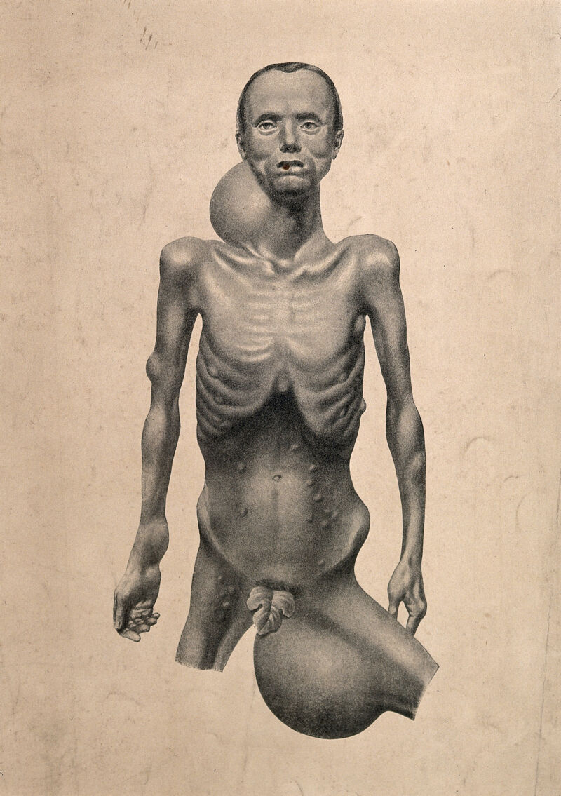 An emaciated naked man, displaying large swellings on his neck and groin,  with smaller swellings visible on his chest, arms, abdomen and thigh.  Process print, 18--. | Wellcome Collection