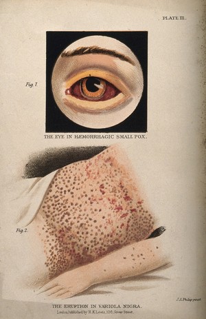 view Above, a bloodshot eye showing symptoms of haemorrhagic smallpox, below, an eruption of variola nigra on the abdomen of a patient. Colour lithograph after J.A. Philip, ca. 1900.