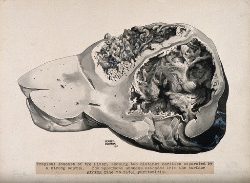 Dissection of the liver, showing a tropical abcess. Ink wash drawing by G. Dorman, ca. 1910.