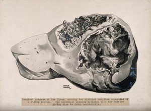 view Dissection of the liver, showing a tropical abcess. Ink wash drawing by G. Dorman, ca. 1910.