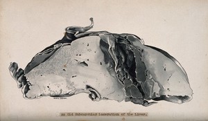 view Dissection of the liver, showing an old subcapsular laceration. Ink wash drawing by G. Dorman, ca. 1910.