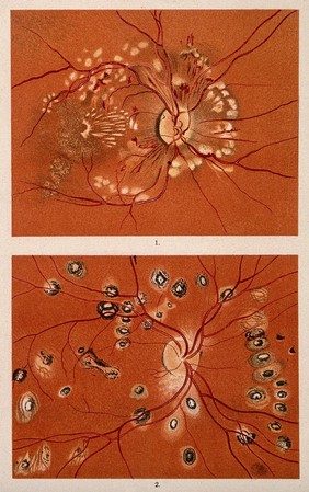 The eye, as seen through a microscope: two figures. Colour lithograph, ca. 1862.