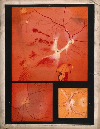 The eye, as seen through a microscope: three figures. Colour lithograph after R. Liebreich, ca. 1860.