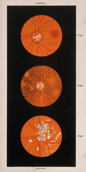 The eye, as seen through a microscope: three figures. Colour lithograph, ca. 1861.