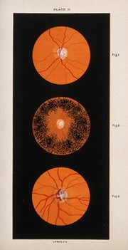 The eye, as seen through a microscope: three figures. Colour lithograph, ca. 1861.