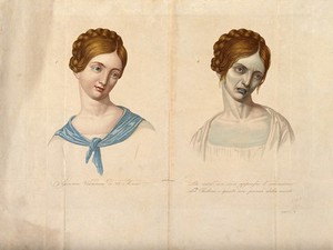 view A young woman of Vienna who died of cholera, depicted when healthy and four hours before death. Coloured stipple engraving.