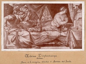 view A woman suffering from elephantiasis, being examined by three people. Reproduction of an oil painting by A. del Sarto.