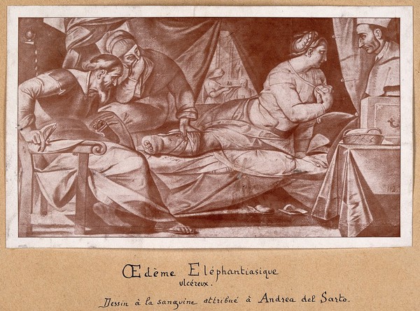 A woman suffering from elephantiasis, being examined by three people. Reproduction of an oil painting by A. del Sarto.