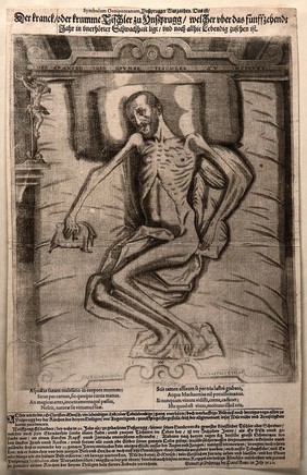 Wolfgang Gschaidtter, a carpenter at Innsbruck, paralyzed for fifteen years, with deformed feet and hands. Line engraving by A. Spängler, 1620.