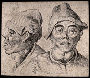 view A man with goitre: front (left) and profile (right) views. Etching by J.R. Schellenberg, 1778.