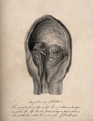 view A human bladder with a tumour. Pencil drawing by G.E. Blenkins, 1831.