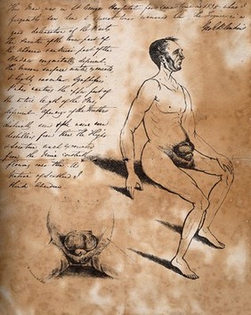 A man with deformities of the lower abdomen. Lithograph by W. Strachan.