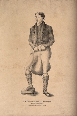 view A man with a huge testicular tumour. Lithograph.