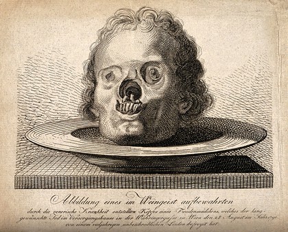 A preserved skull of a woman who had been suffering from syphilis, died in 1796. Line engraving.