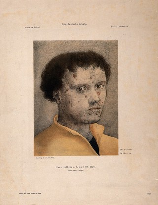 A young man with an ulcerated face. Lithograph after H. Holbein.
