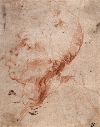 A man with goitre. Chalk drawing by J. de Ribera.