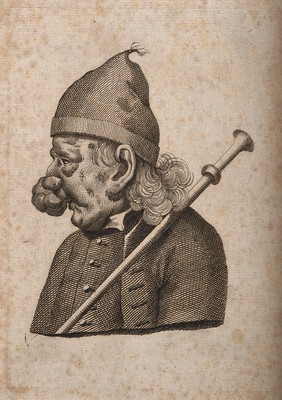 Profile of a man with extensive growths on his nose. Line engraving.