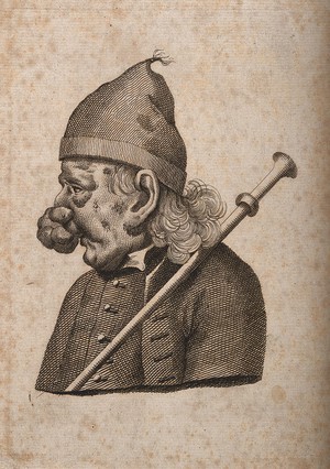 view Profile of a man with extensive growths on his nose. Line engraving.