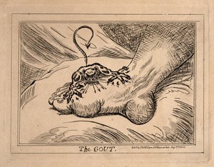 view A swollen and inflamed foot: gout is represented by an attacking demon. Etching, 1835, after J. Gillray, 1799.