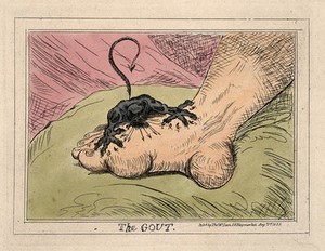 view A swollen and inflamed foot: gout is represented as an attacking demon. Coloured etching, 1835, after J. Gillray, 1799.