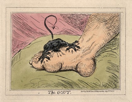 A swollen and inflamed foot: gout is represented as an attacking demon. Coloured etching, 1835, after J. Gillray, 1799.