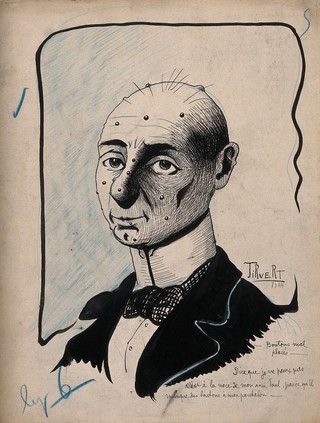 A glum Frenchman: he has plenty of 'buttons' (French boutons, i.e. moles, nodules or naevi) on his face, but lacks them on his trousers. Coloured pen and ink drawing by Tirvert.