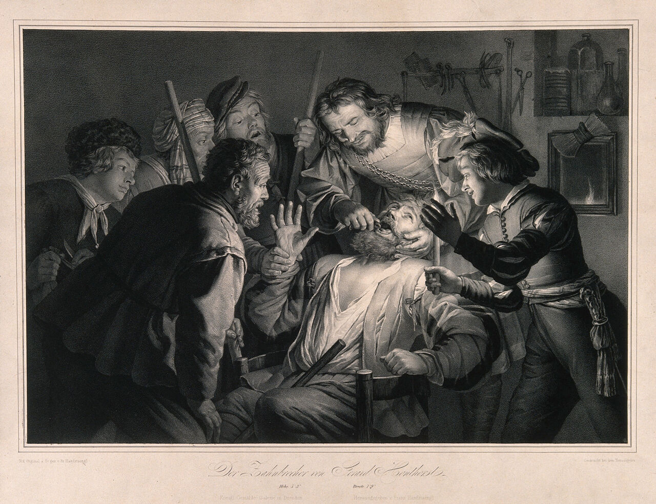 A tooth-drawer in his practice extracting a tooth from a seated patient who is surrounded by friends and family holding candles. Lithograph by F. Hanfstaengl after G. van Honthorst., by Gerard van Honthorst