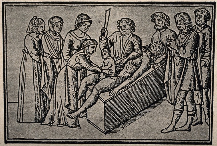 The birth of Julius Caesar from his dead mother. Reproduction