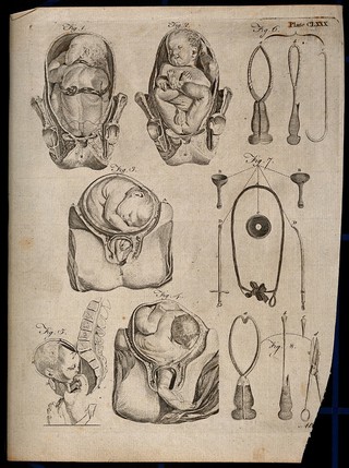 Eight diagrams illustrating difficult births and obstetrical instruments. Engraving by A. Bell.