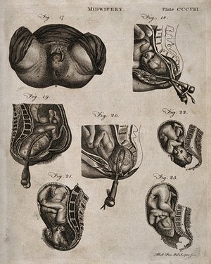 view Seven diagrams illustrating the birth of a child with the use of forceps. Engraving by A. Bell.