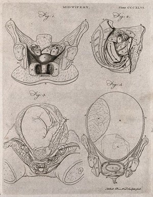 view Four cross-sections of figures of the pregnant uterus. Engraving by A. Bell.