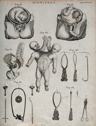 Seven diagrams illustrating difficult births, obstetrical instruments and a conjoined twin. Etching by Barlow.